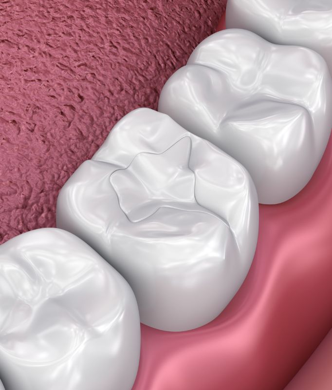 Dental Fillings in NW6 - Photo of a design graphic showing a white filling in a tooth