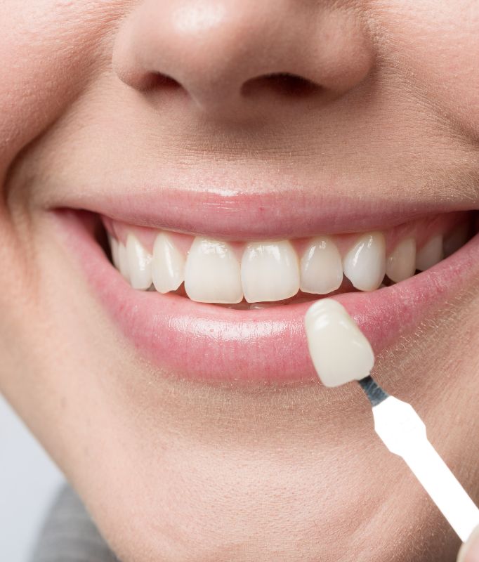Closeup image of mouth and dental veneer. Dental veneers Kilburn at Shape Dental.