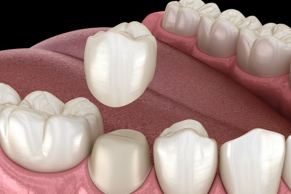 Image of a Dental Crown