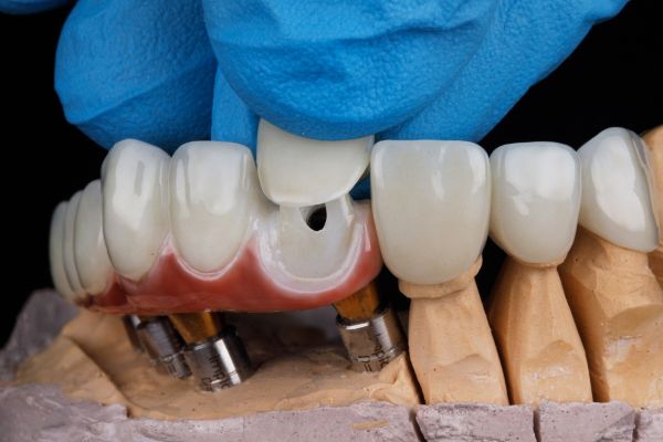 Image of dental implants